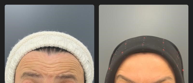 botox
