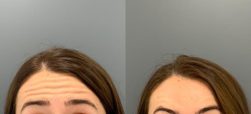 botox