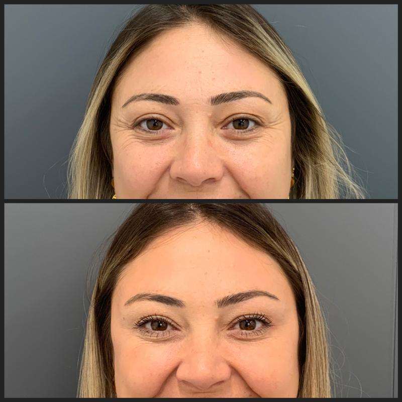botox
