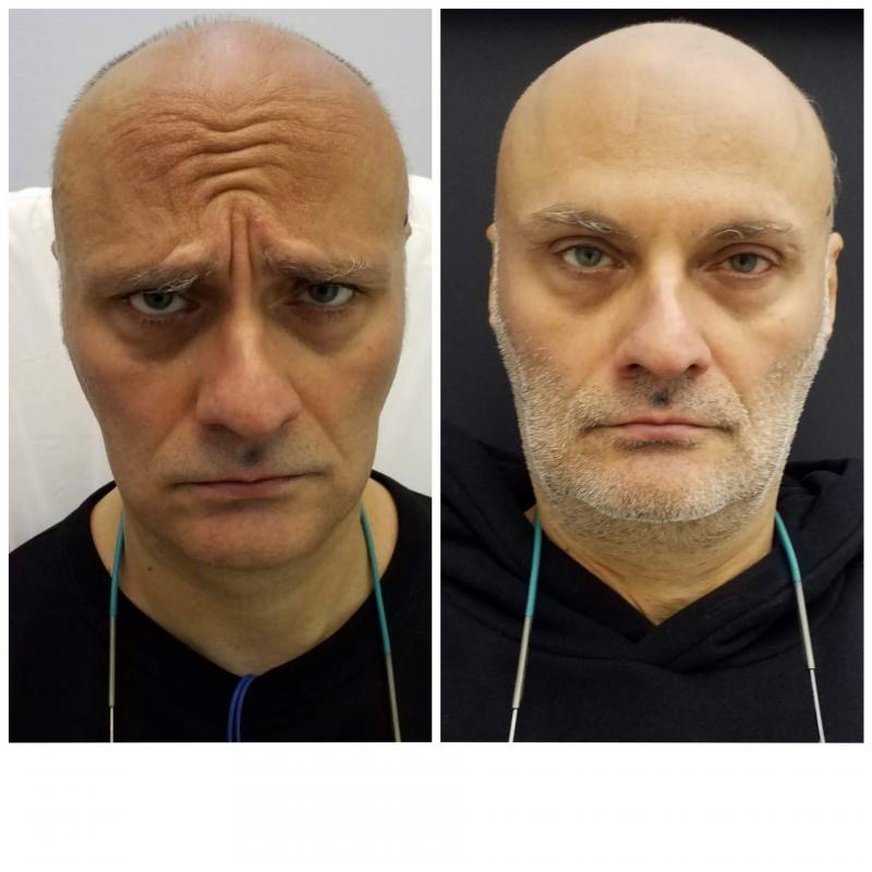 botox