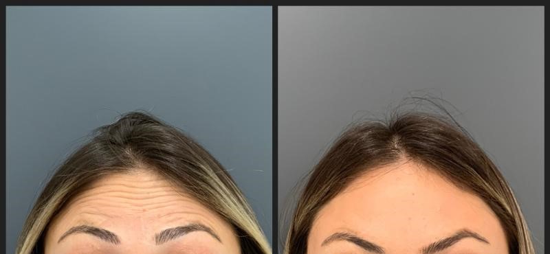 botox