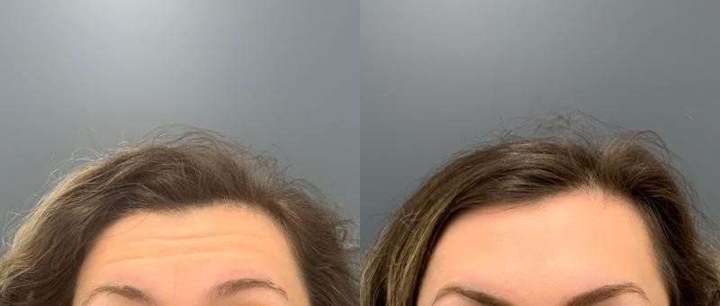botox