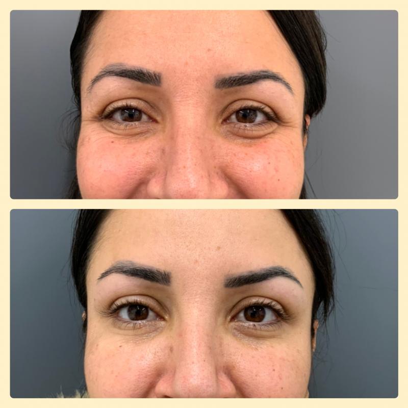 botox