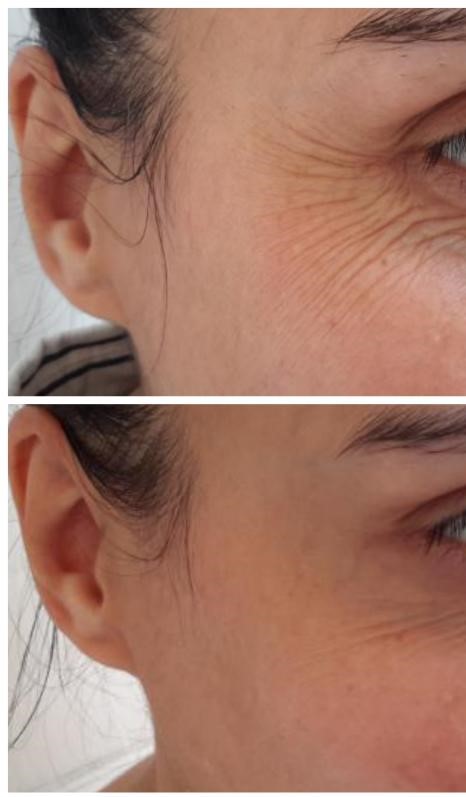 botox